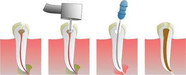 Root Canal Treatment