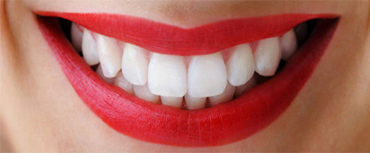 Veneers