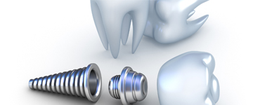 Dental Implants